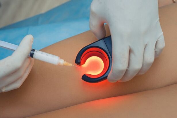 Treatment of varicose veins using sclerotherapy